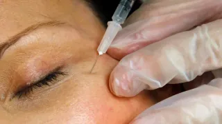 FDA Warns Websites Selling Unapproved Botox for Cosmetic Purposes